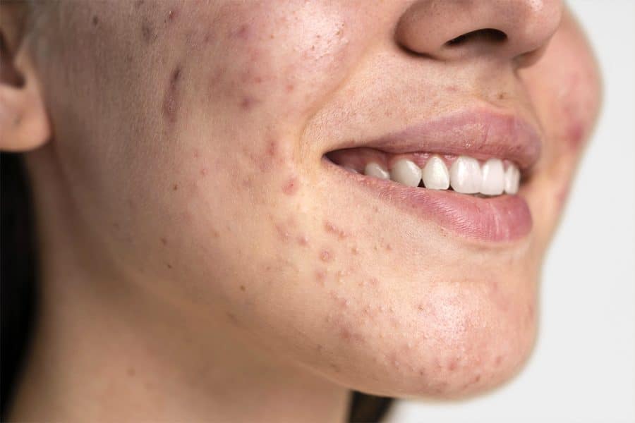 confident-young-woman-with-acne-close-up-grey-1080